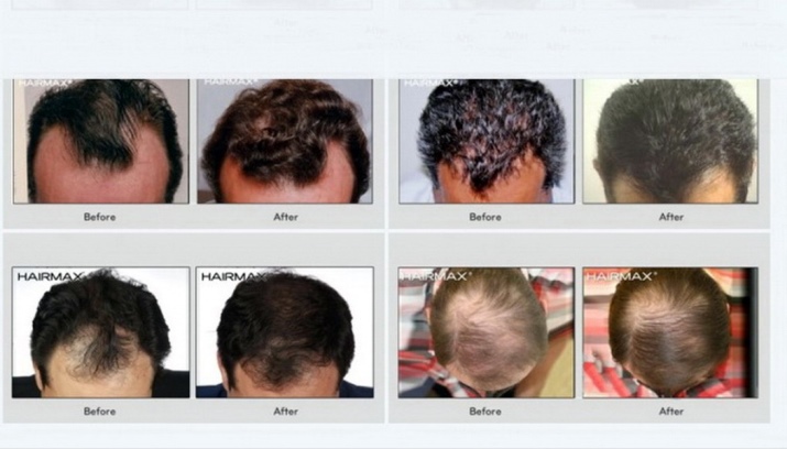 Лазерная расческа: лазерные расчески от Hairmax от выпадения и для роста волос, отзывы () Лазерная расческа: лазерные расчески от Hairmax от выпадения и для роста волос, отзывы